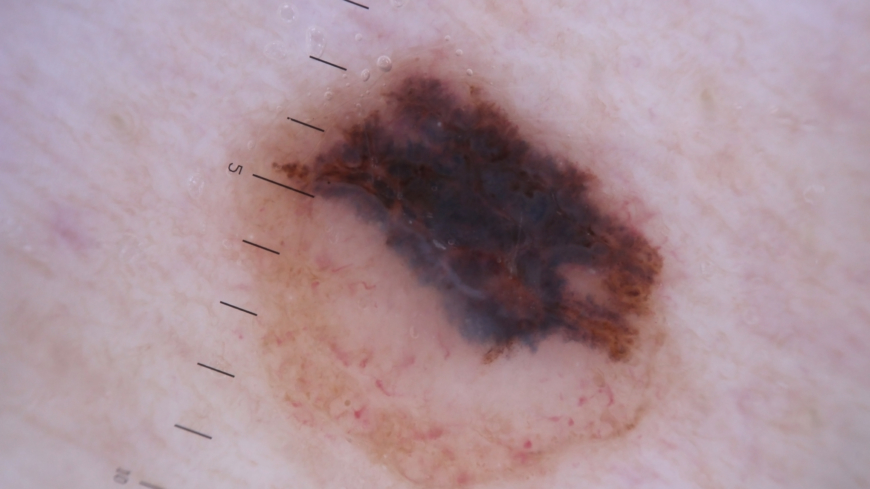 Tio år tillbaka överlevde endast en av 20 patienter som diagnostiserats med malignt melanom i ett sent stadium.  Foto: Shutterstock
